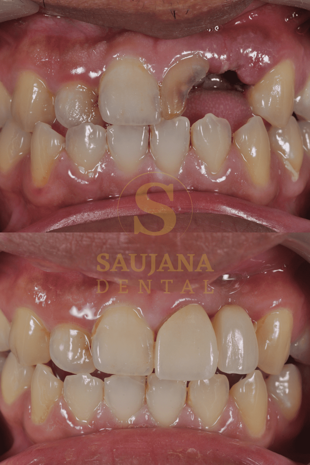 Anterior Bridge(Cantilever)