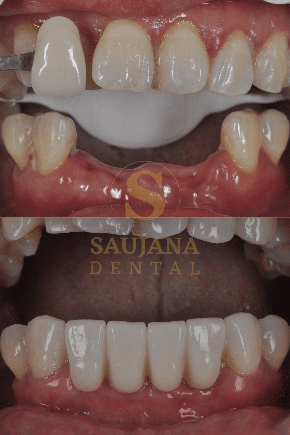 Anterior Bridge(Conventional) (2)