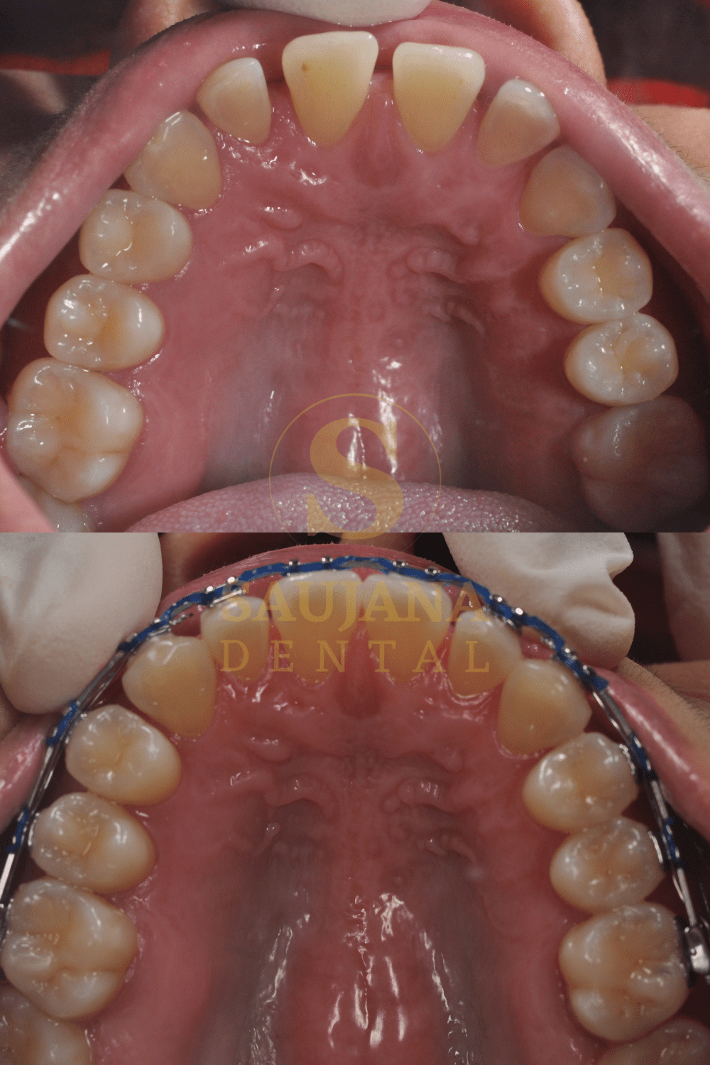 Conventional Braces (10)