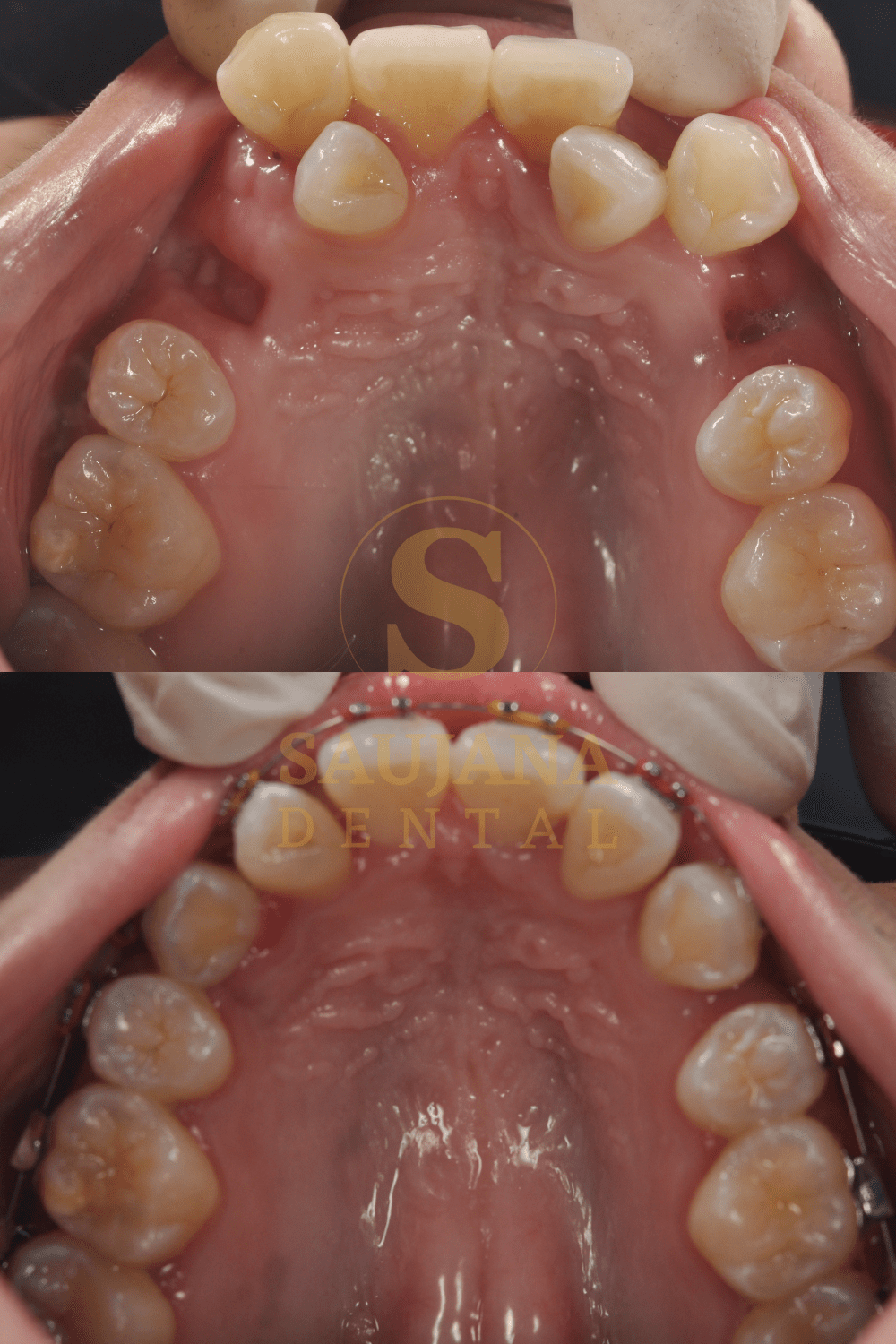 Conventional Braces (2)