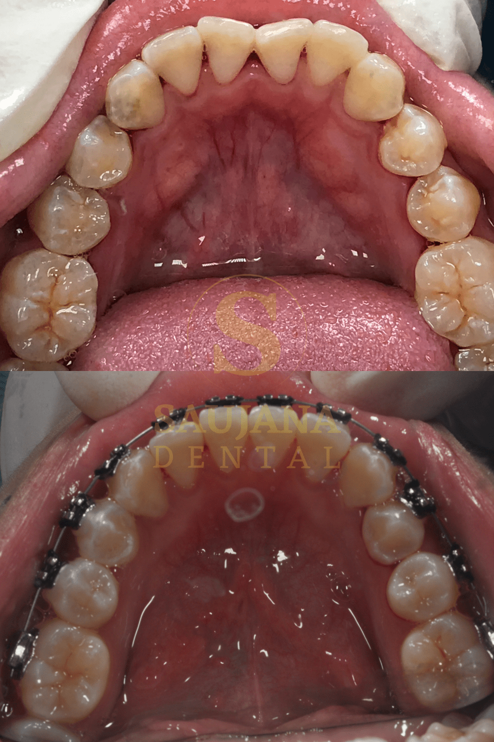 Conventional Braces (3)