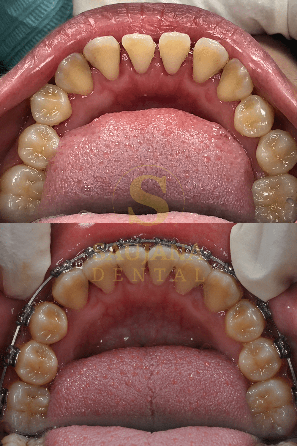 Conventional Braces (4)