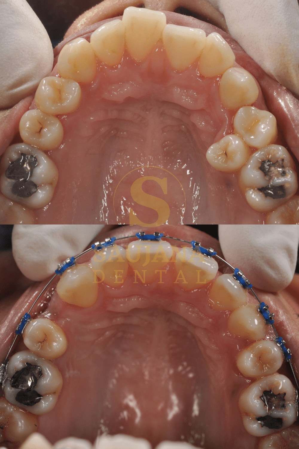 Conventional Braces (5)