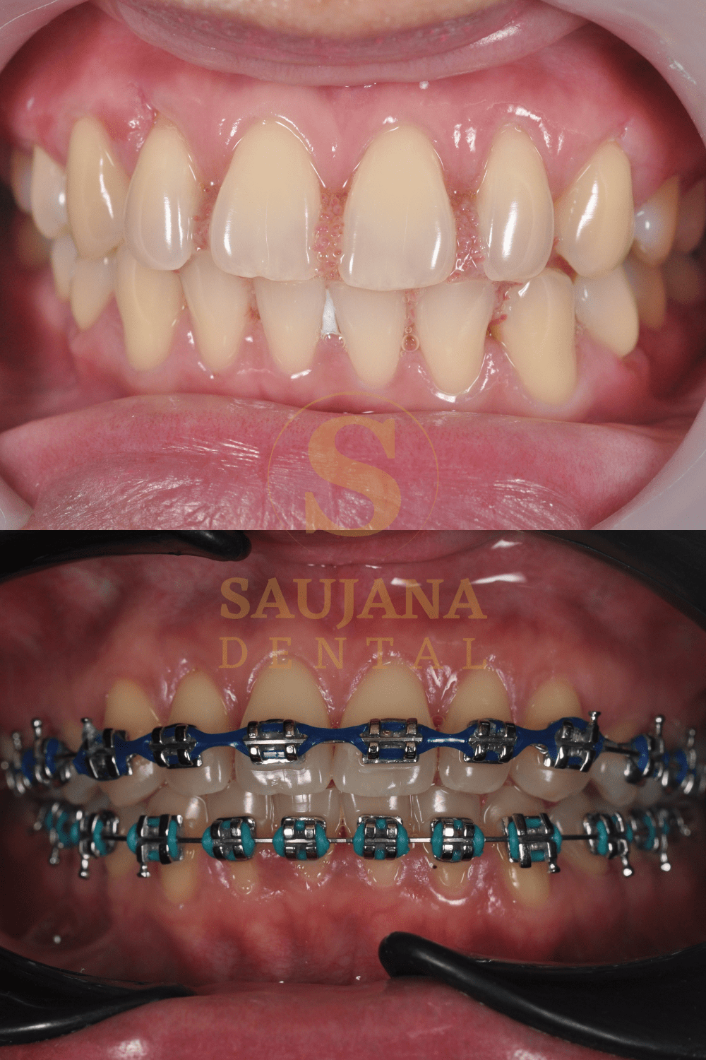 Conventional Braces (6)