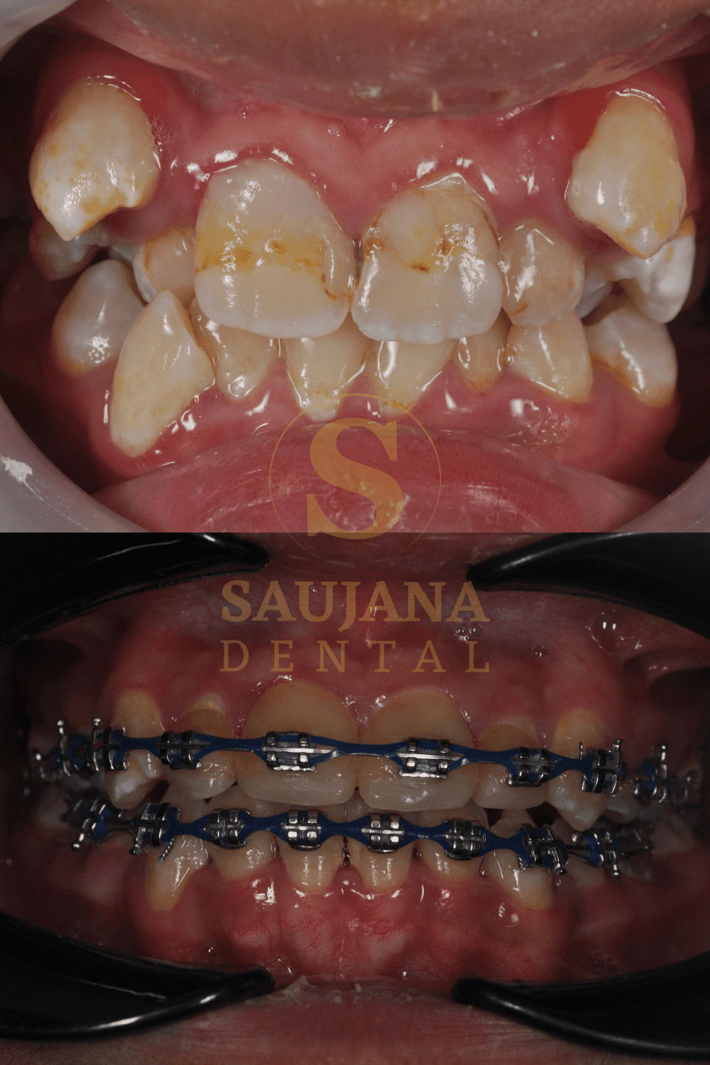 Conventional Braces (7)