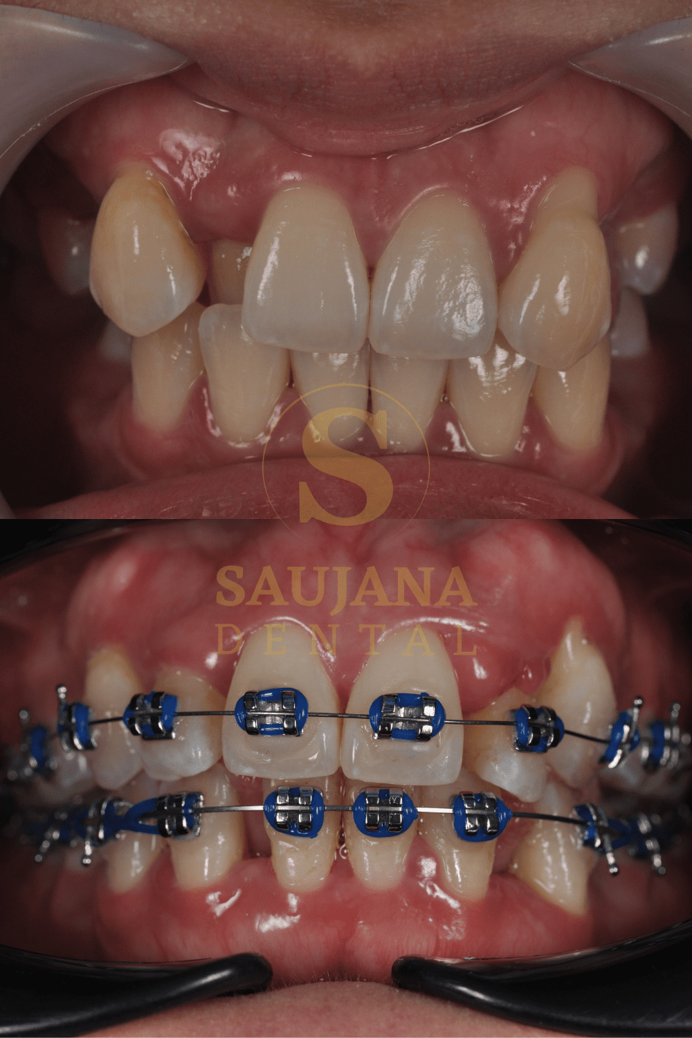 Conventional Braces (8)