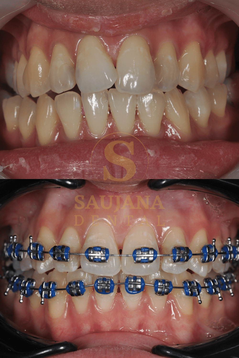 Conventional Braces (9)