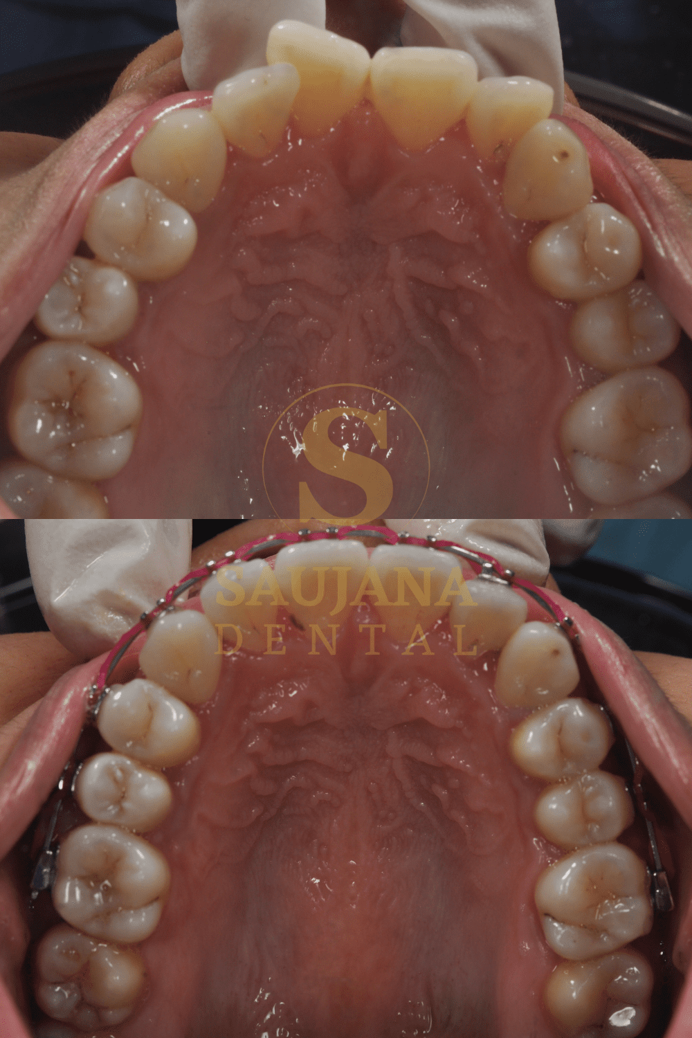 Conventional Braces