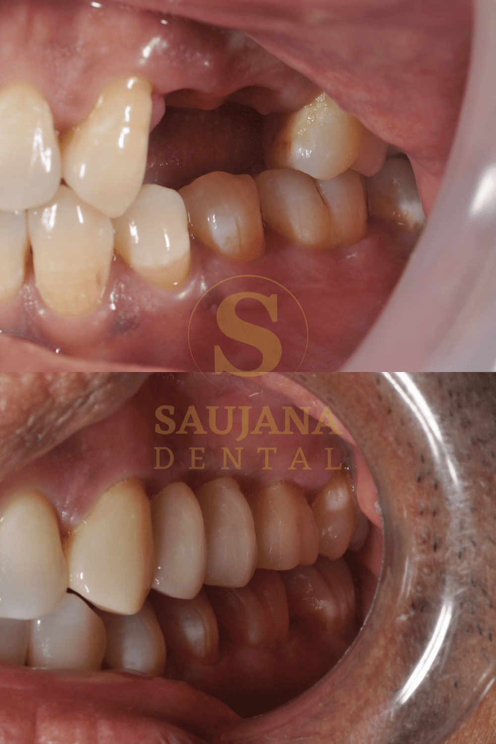 Posterior Bridge(Conventional) (2)