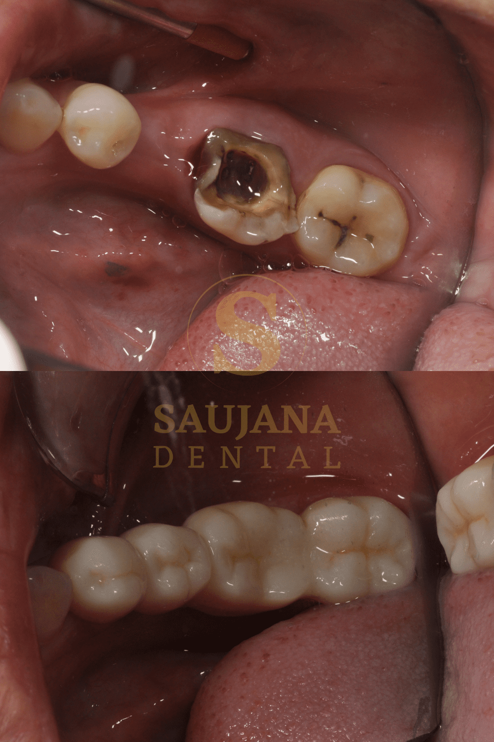 Posterior Bridge(Conventional) (3)