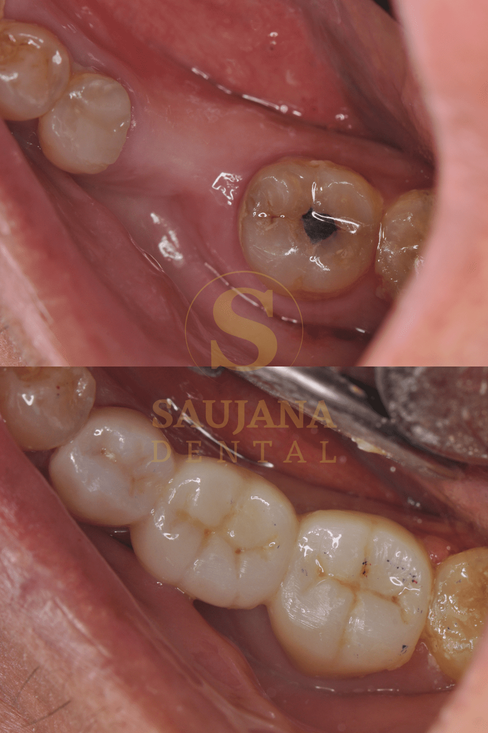 Posterior Bridge(Conventional)