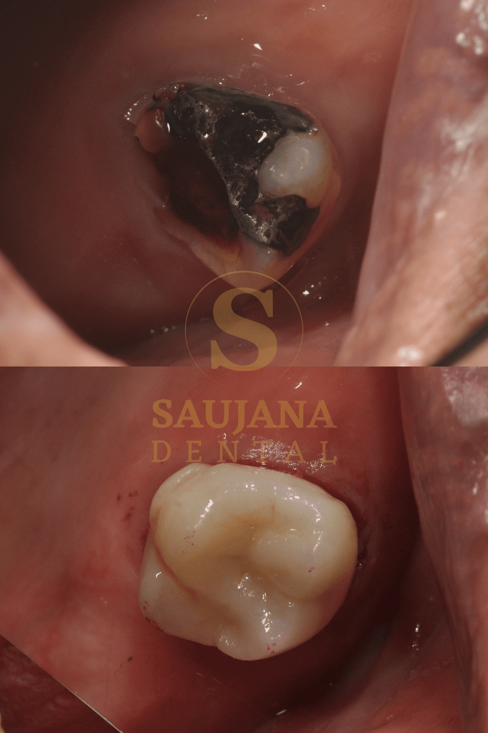 Posterior Crown