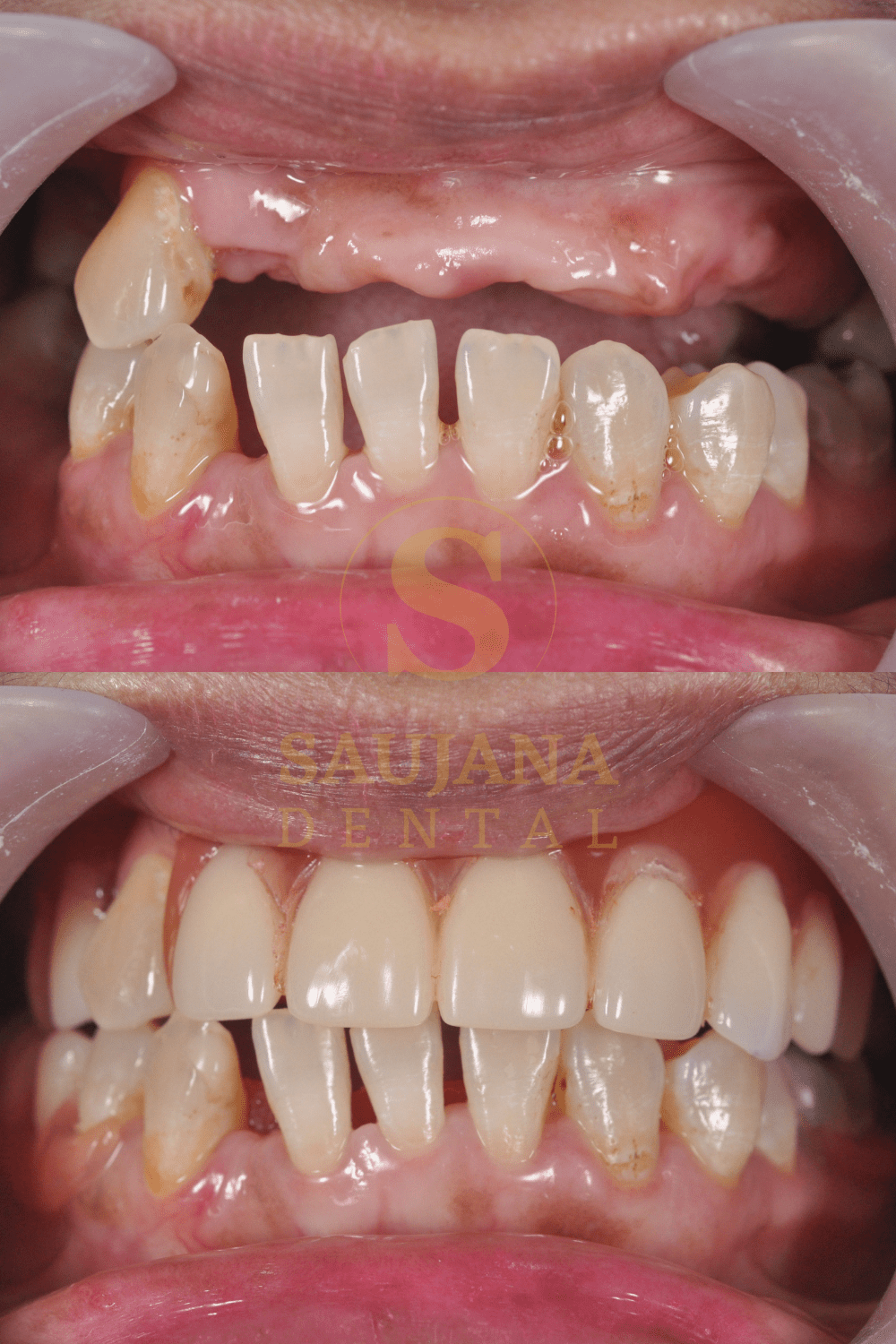 Valplast Denture (10)