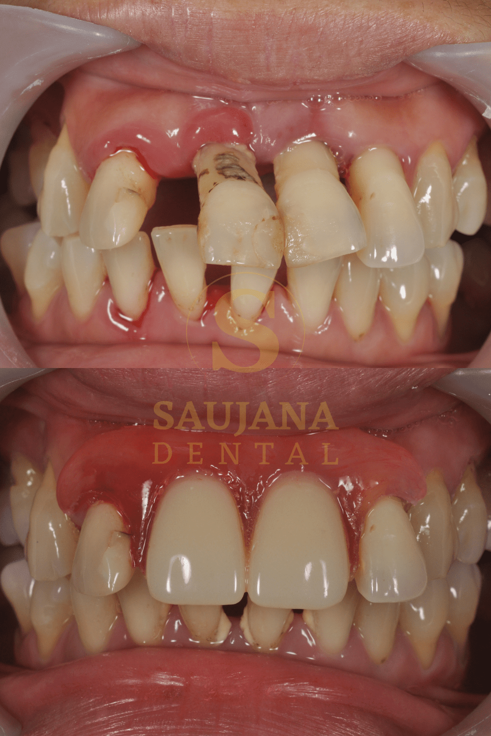 Valplast Denture (11)