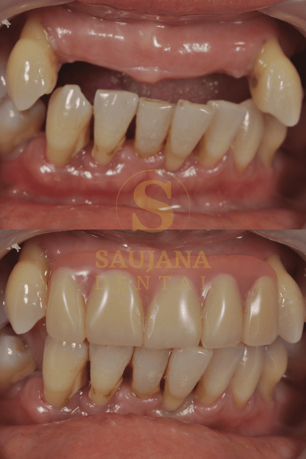 Valplast Denture (2)