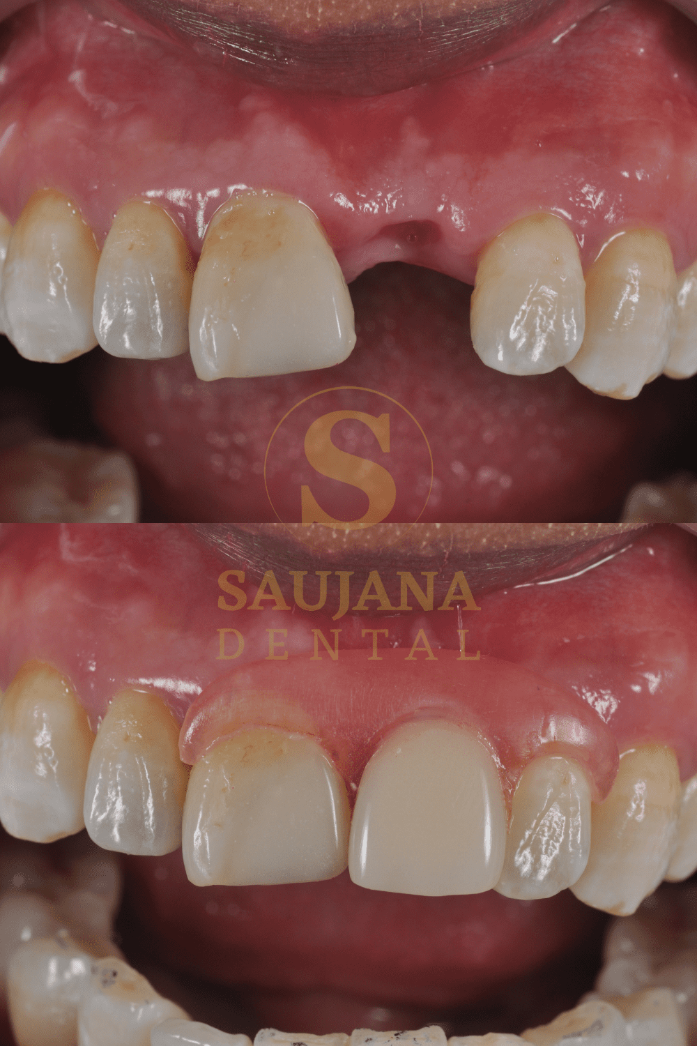 Valplast Denture (3)