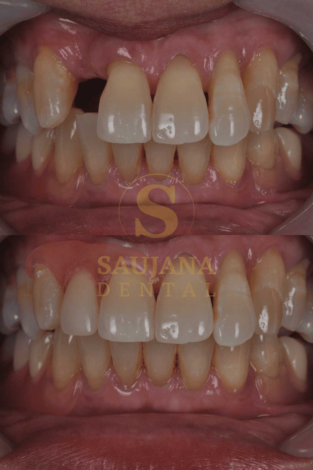 Valplast Denture (4)