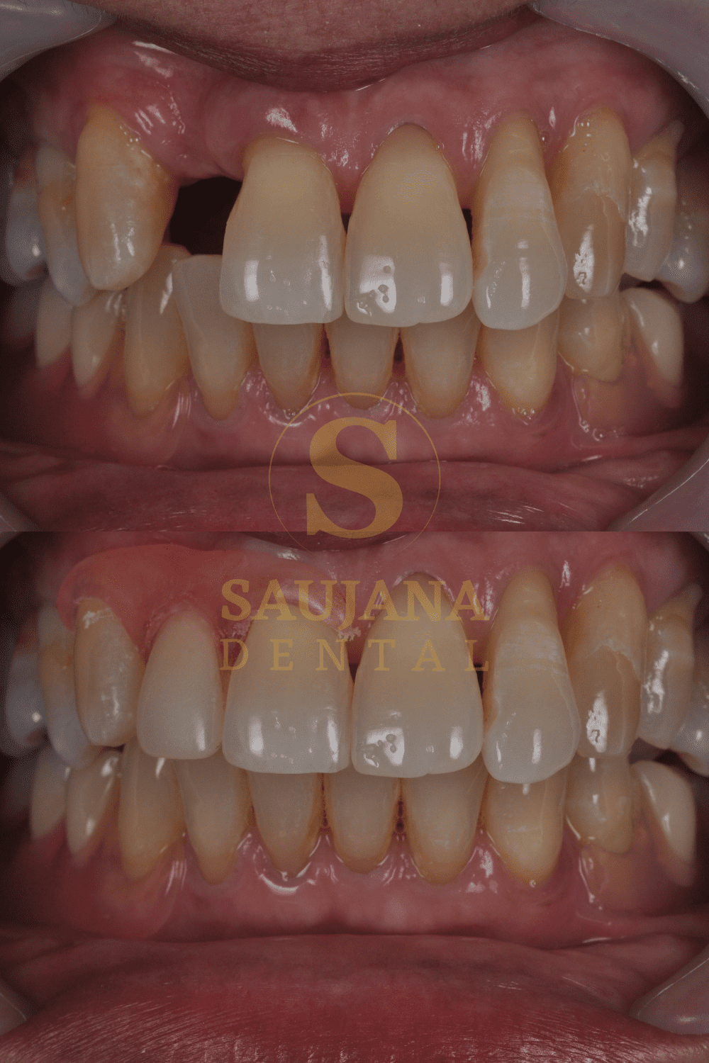 Valplast Denture (5)