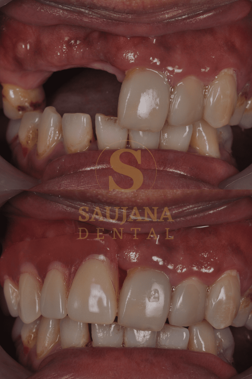 Valplast Denture (6)