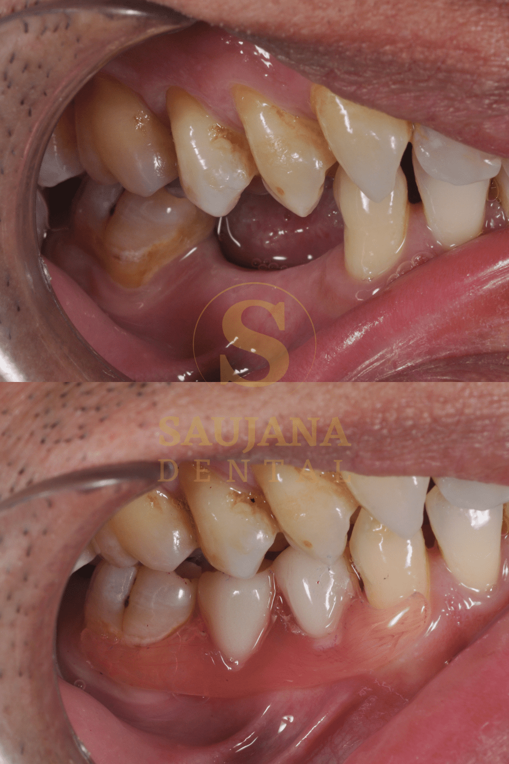 Valplast Denture (7)