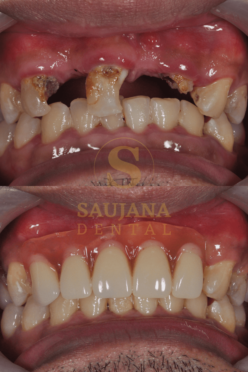 Valplast Denture (8)