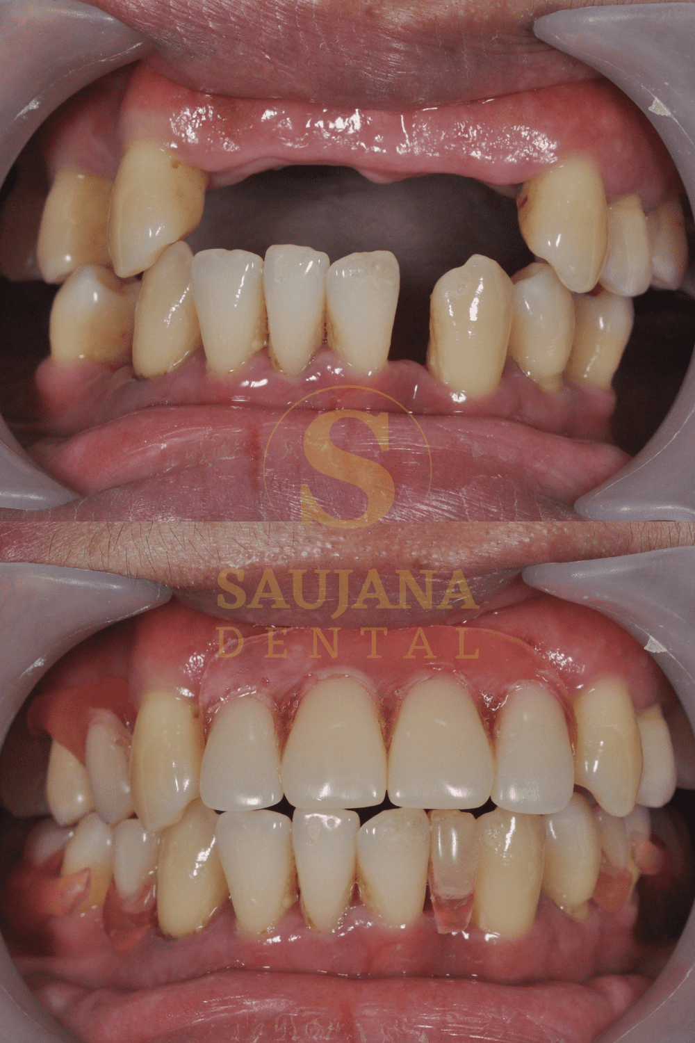 Valplast Denture (9)