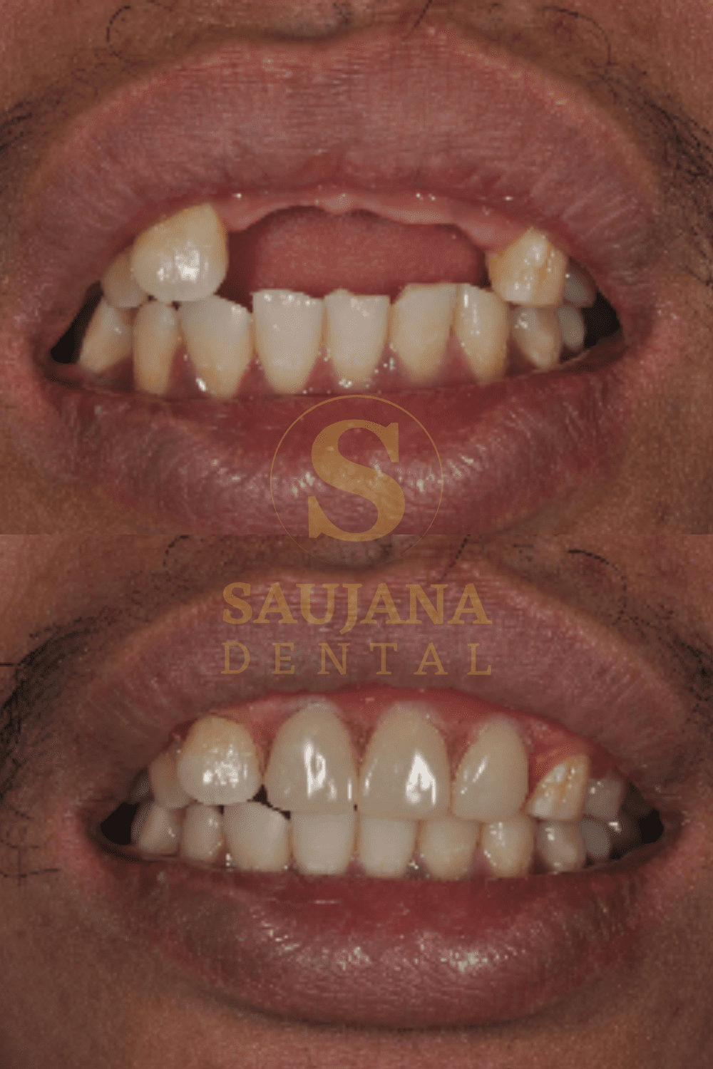 Valplast Denture