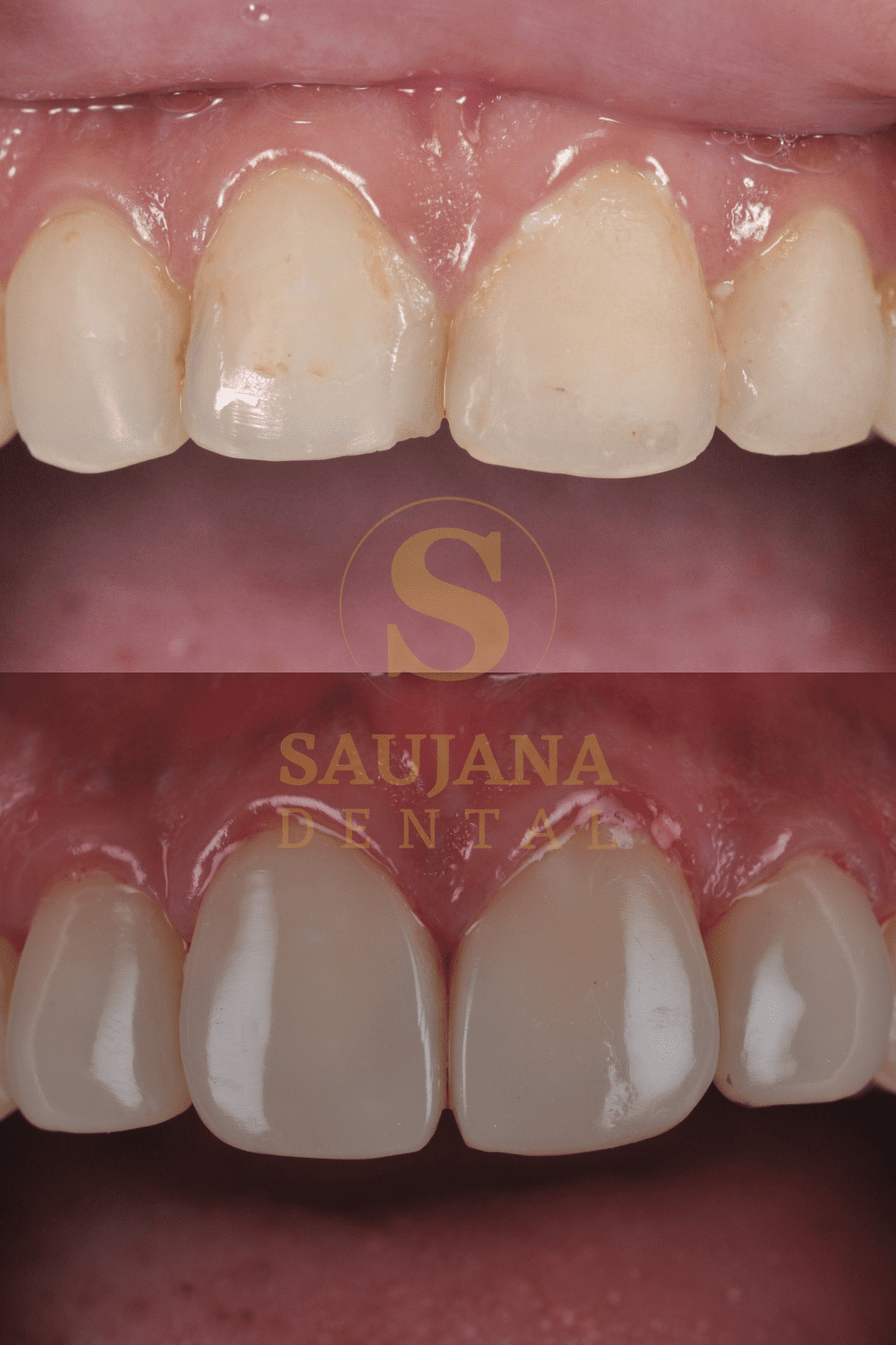 Composite Veneer (3)